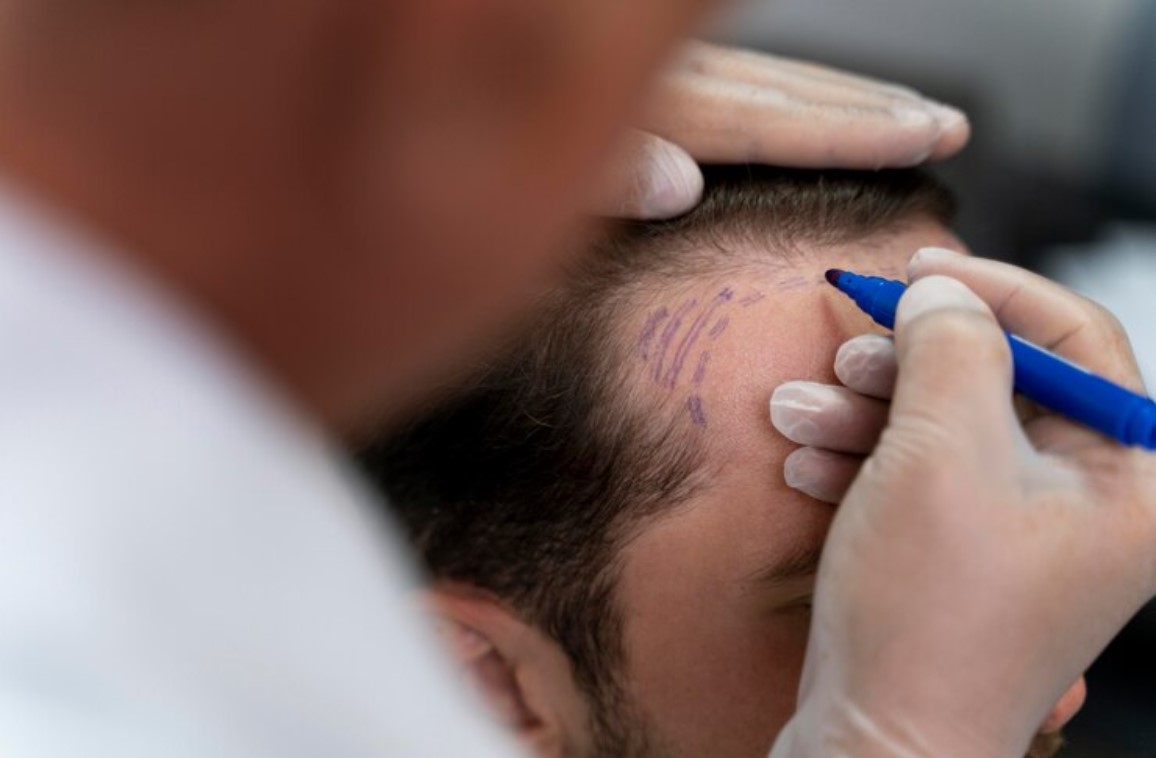 Exploring Scalp Micropigmentation: Side Effects and Benefits