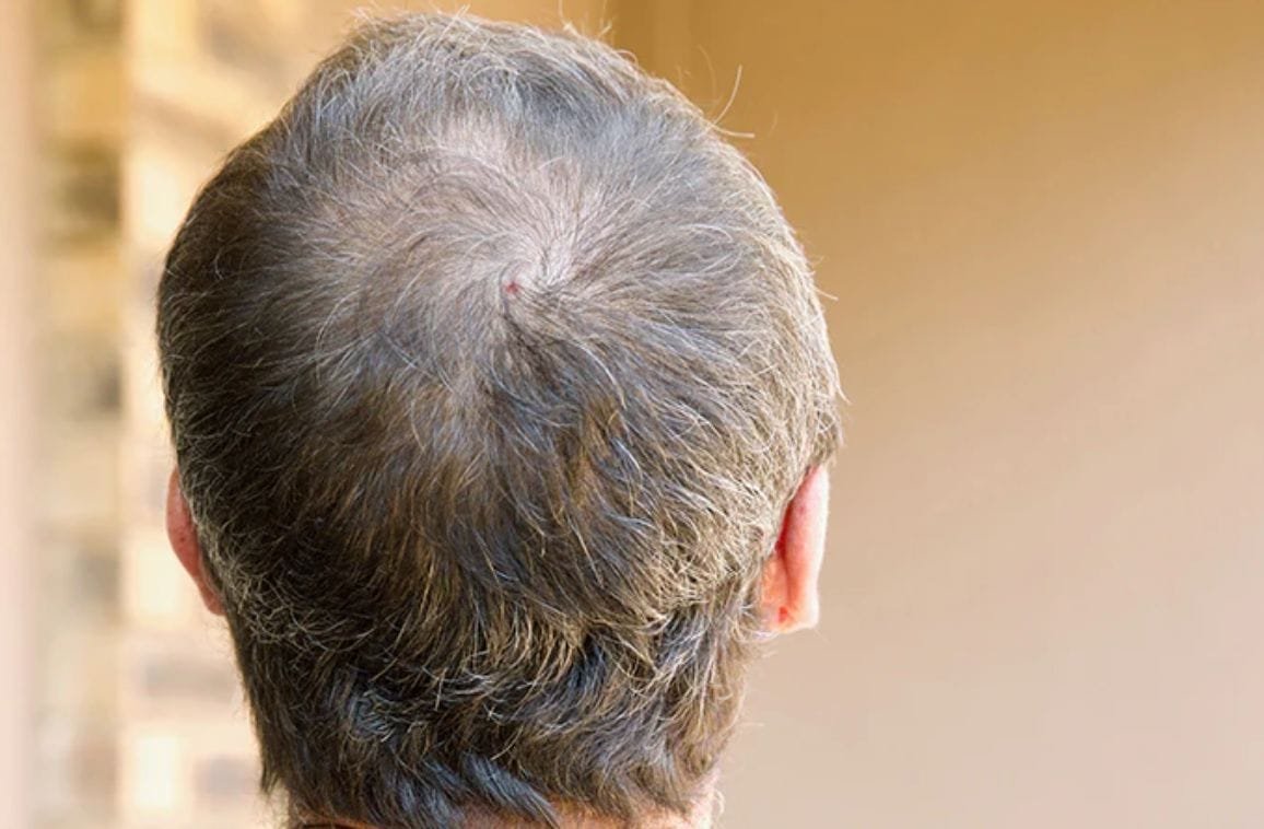 Scalp Infections: Signs, Prevention, and Treatments