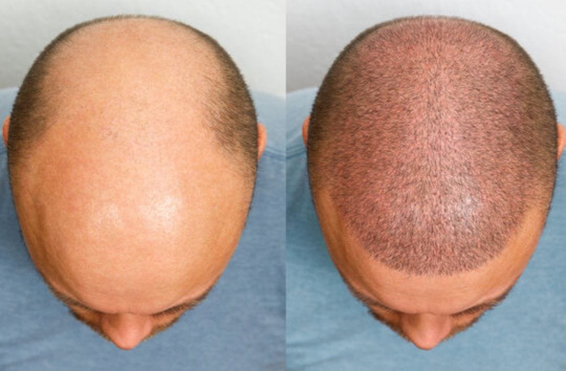 Is Surgical Hair Replacement Worth It? Pros and Cons