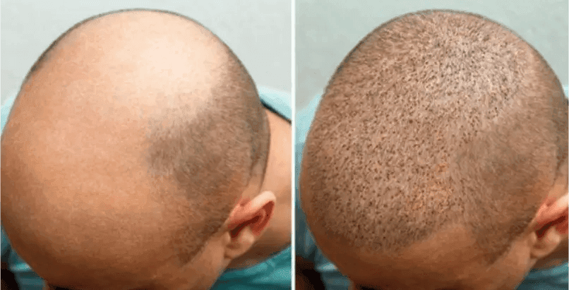 Scalp Micropigmentation