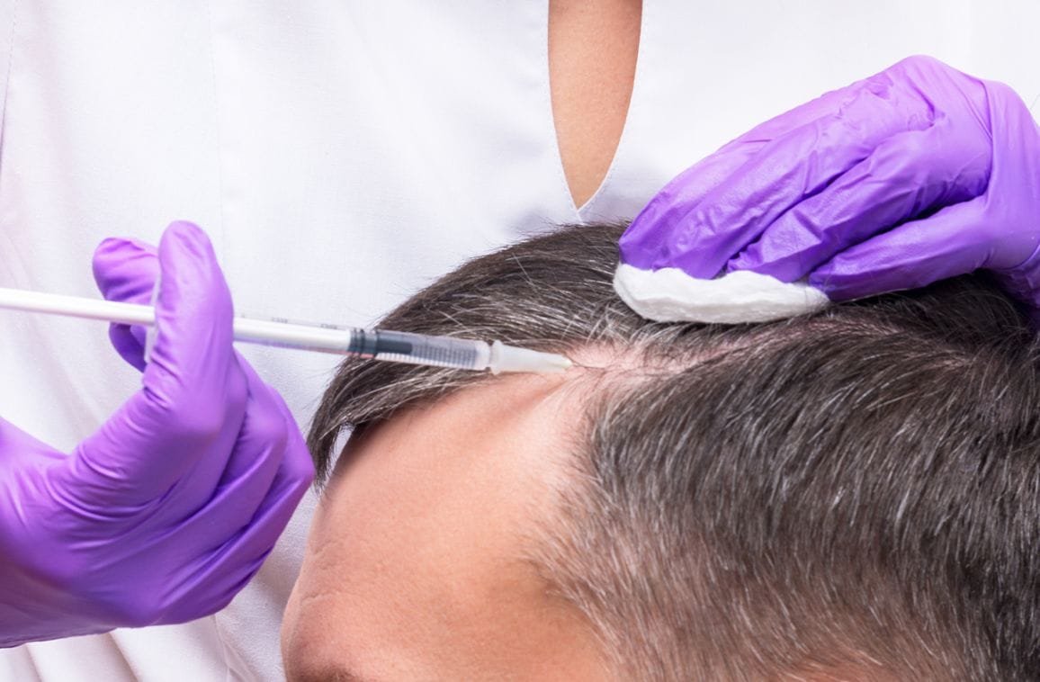 What is PRP therapy for hair loss, and how does it work?