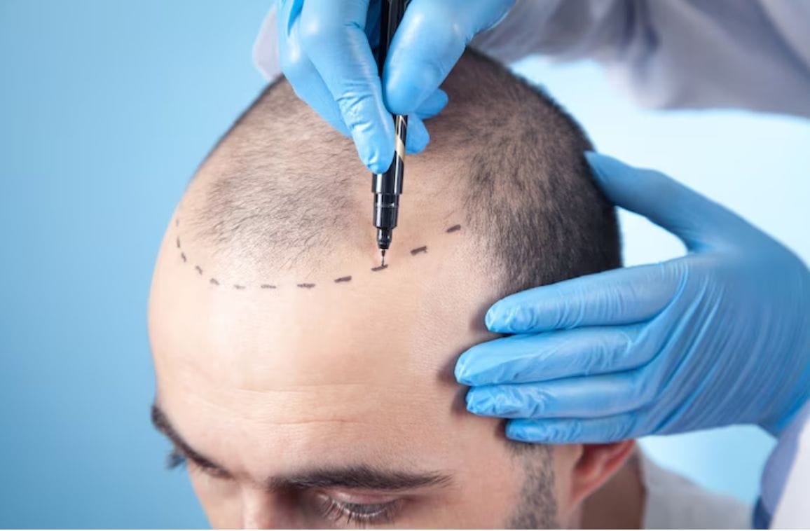 Surgical Hair Transplant: A Permanent Solution for Hair Loss