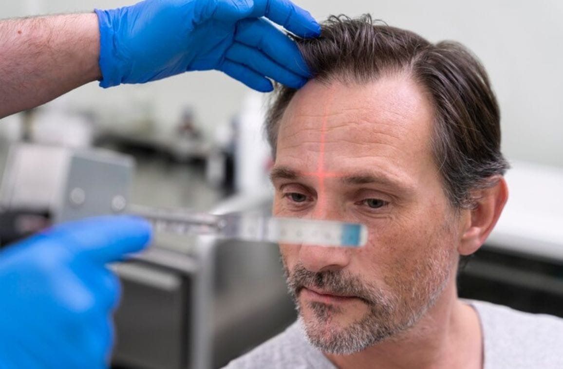 Surgical Hair Transplant: A Permanent Solution for Hair Loss