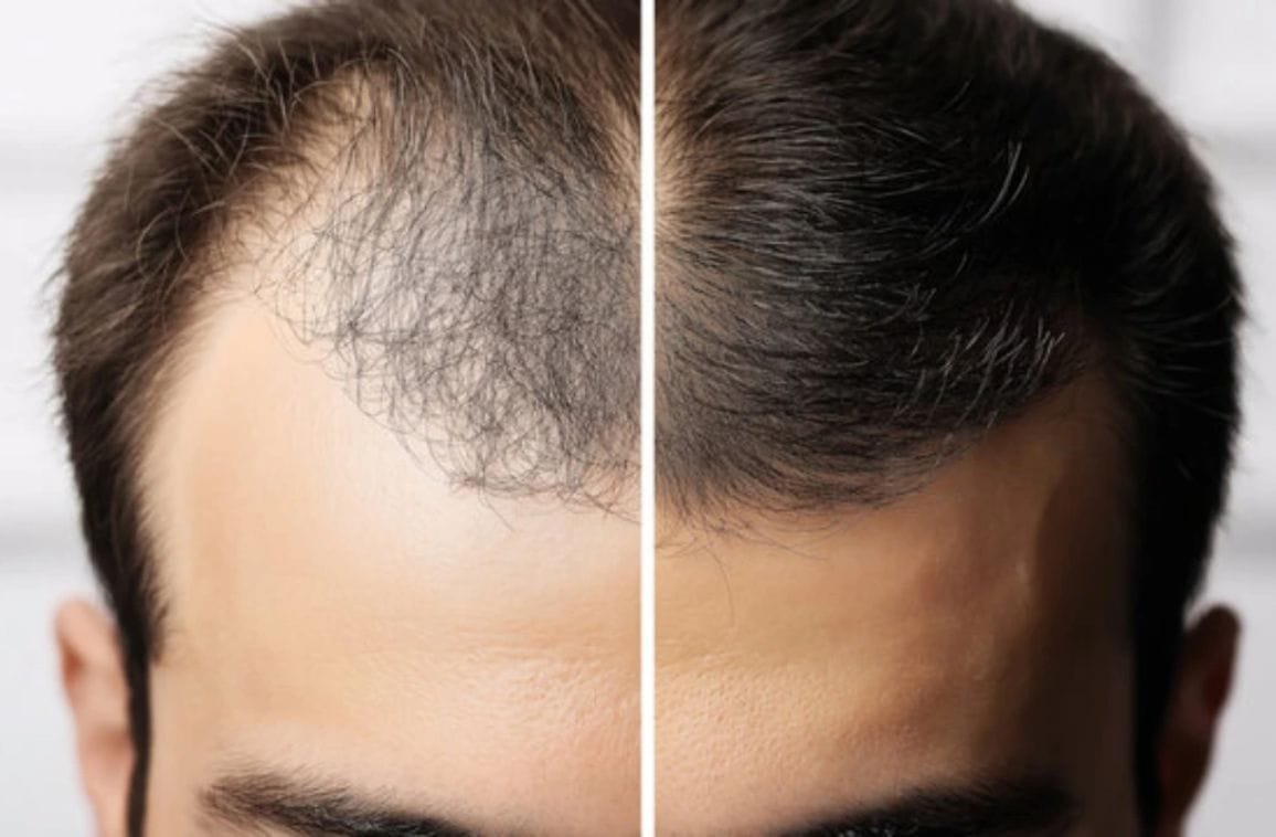 Hair Replacement Therapy: Benefits & Results