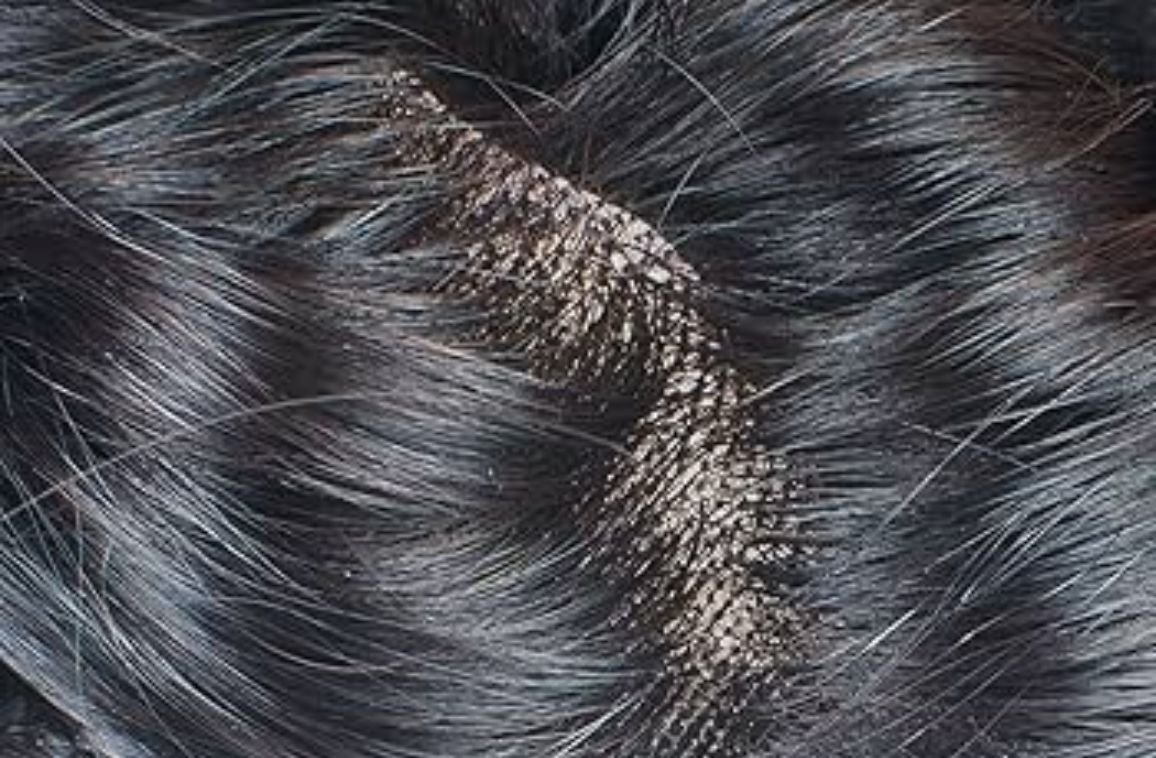 Hair Patch Clip System: How It Works and Who It’s Best For