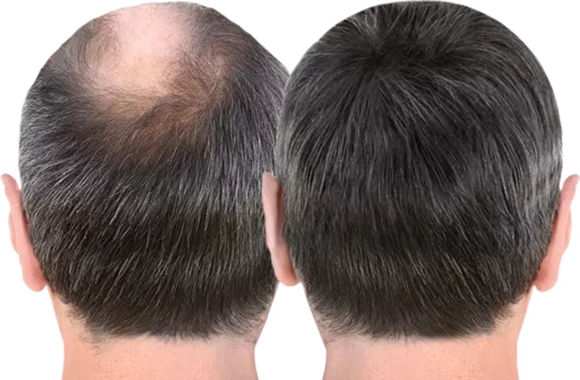 Best Hair Bonding: Why It’s the Most Loved Non-Surgical Option