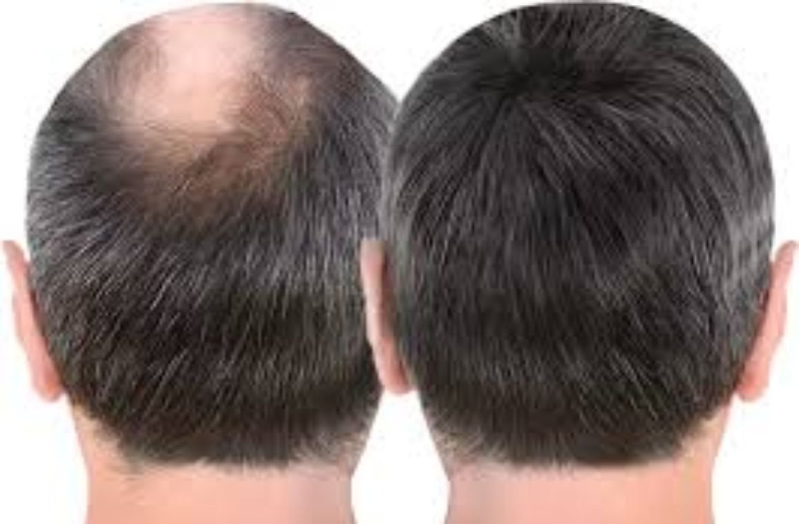 Best Hair Patch in Hyderabad for Men with Hair Loss!